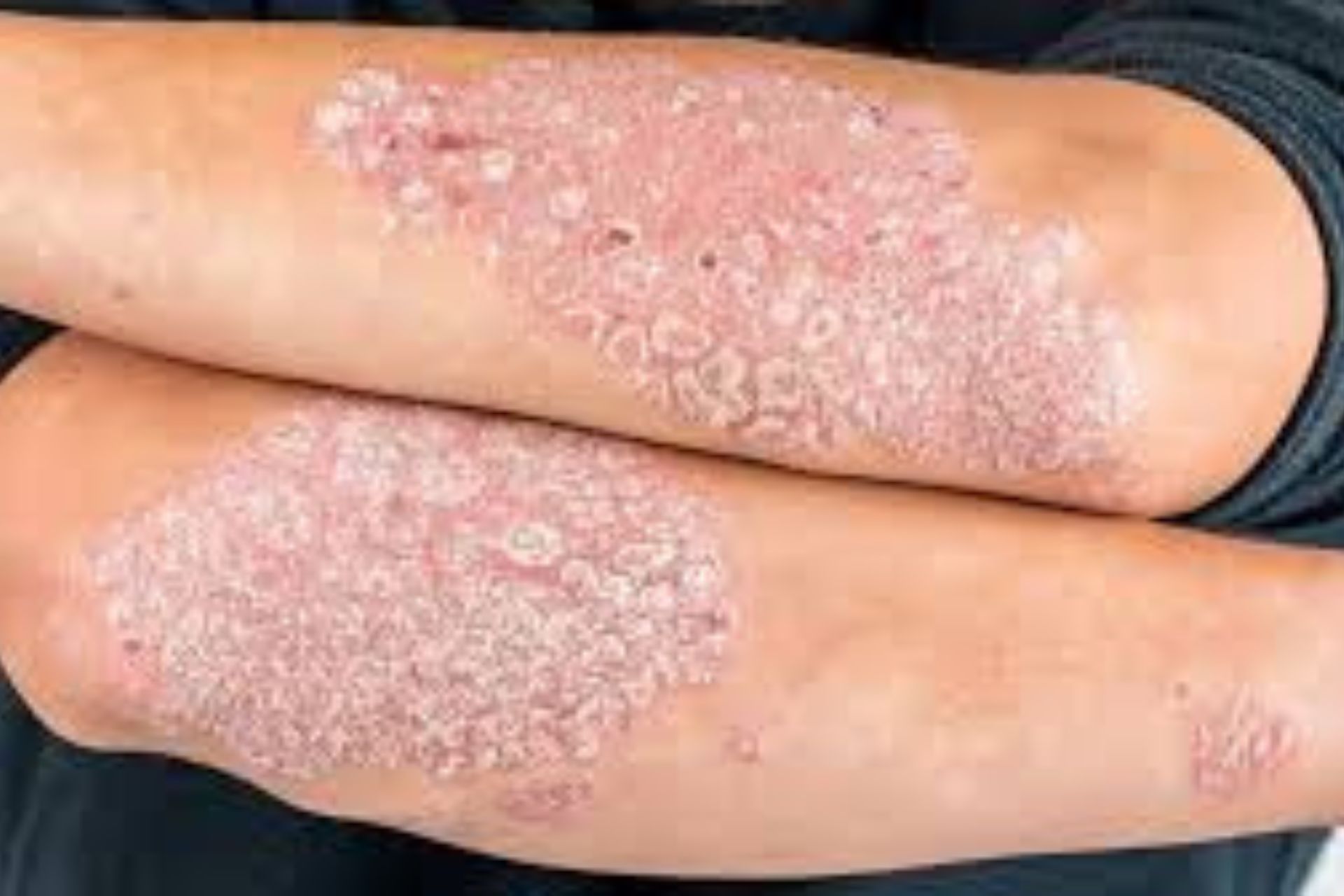 সোরিয়াসিস কি? সোরিয়াসিস থেকে মুক্তির উপায়